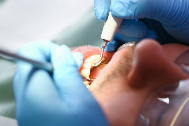 Best Emergency Wisdom Teeth Removal in Hillsboro, WI